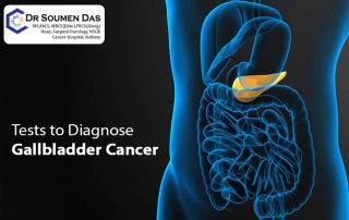 gallbladder cancer doctor