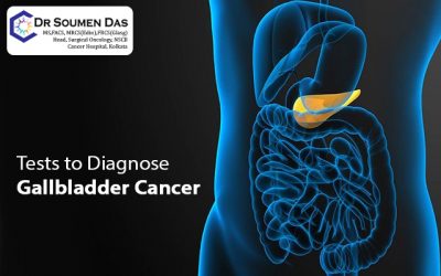 Tests to Diagnose Gallbladder Cancer. Laparoscopic surgeon discussed